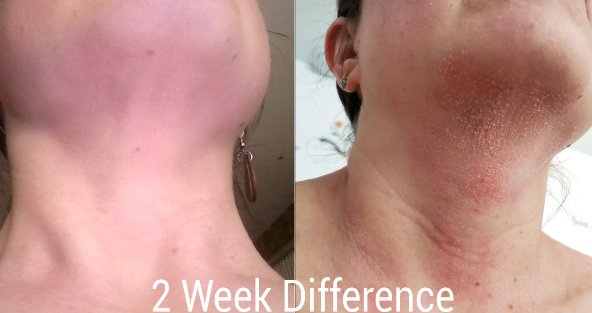 Psoriasis before after picture