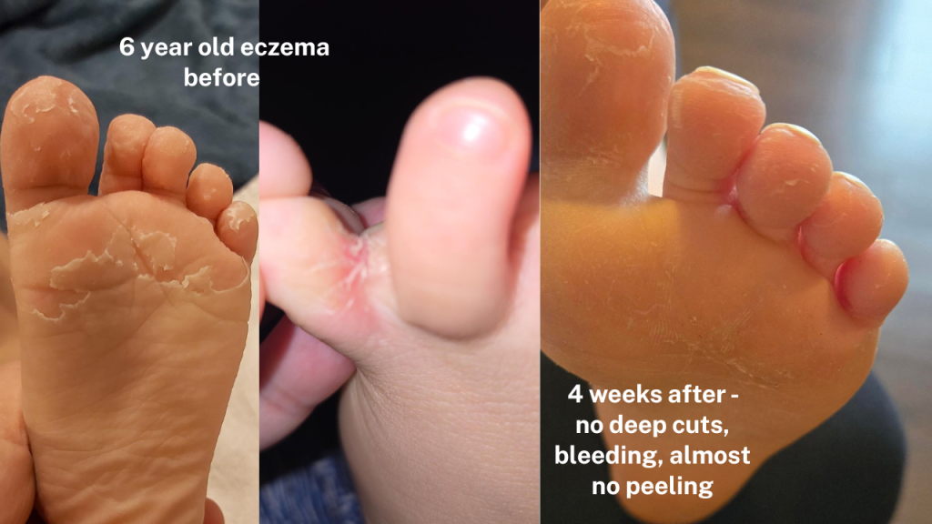 eczema before and after 6 year old