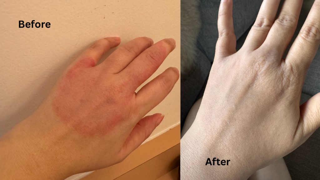 Eczema before and after